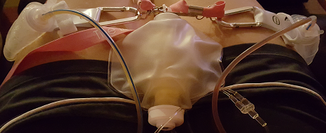 The glamorous side of surgery, pain pump and drains.